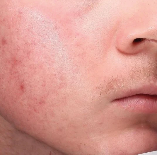 After 2 Treatments