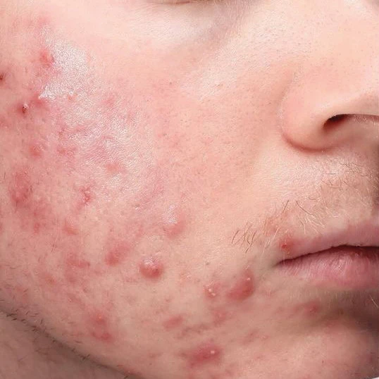 Acne · Before