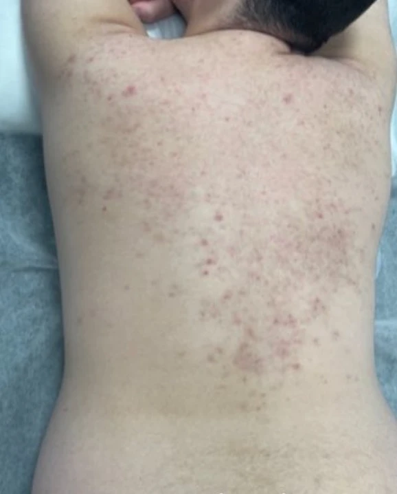 After 3 Treatments