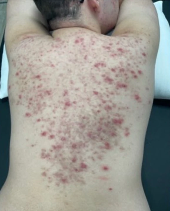 Acne · Before