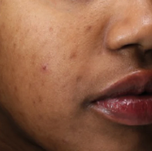 After 5 Treatments