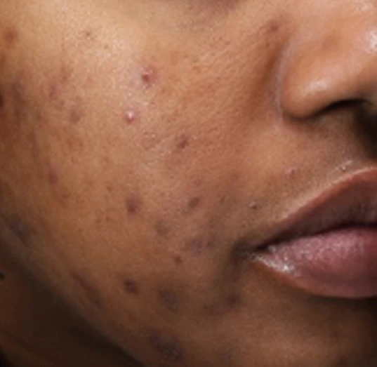Acne · Before