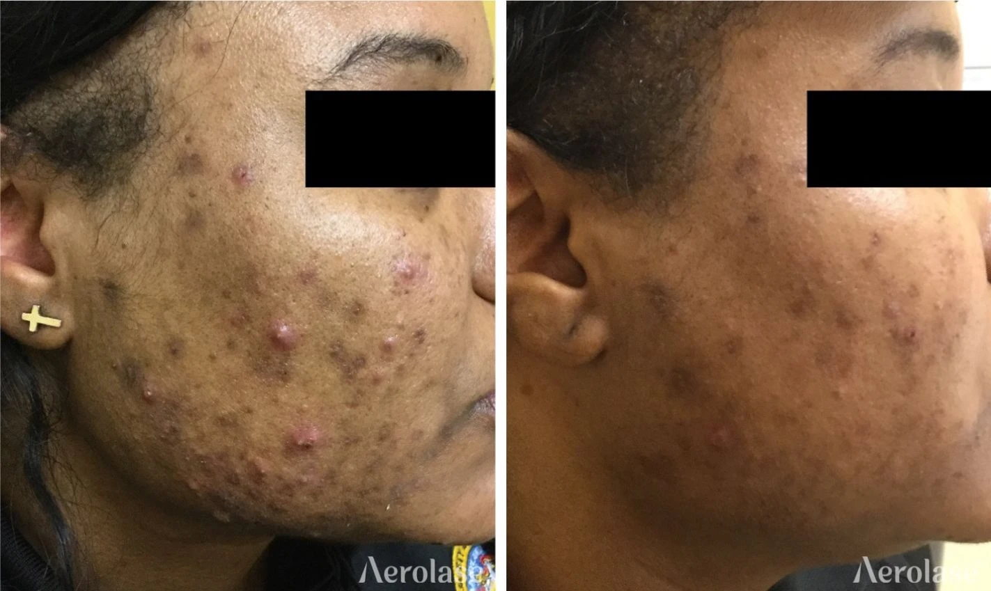 Acne clearance before and after with the Aerolase Neo