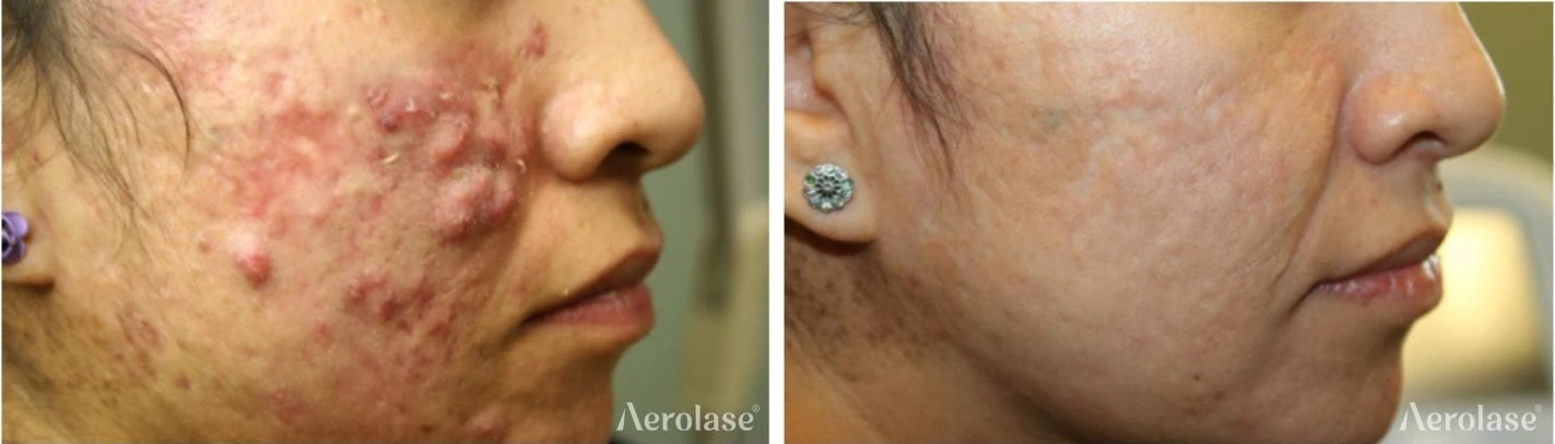 Acne · 5 Treatments before and after — Aerolase Neo Elite