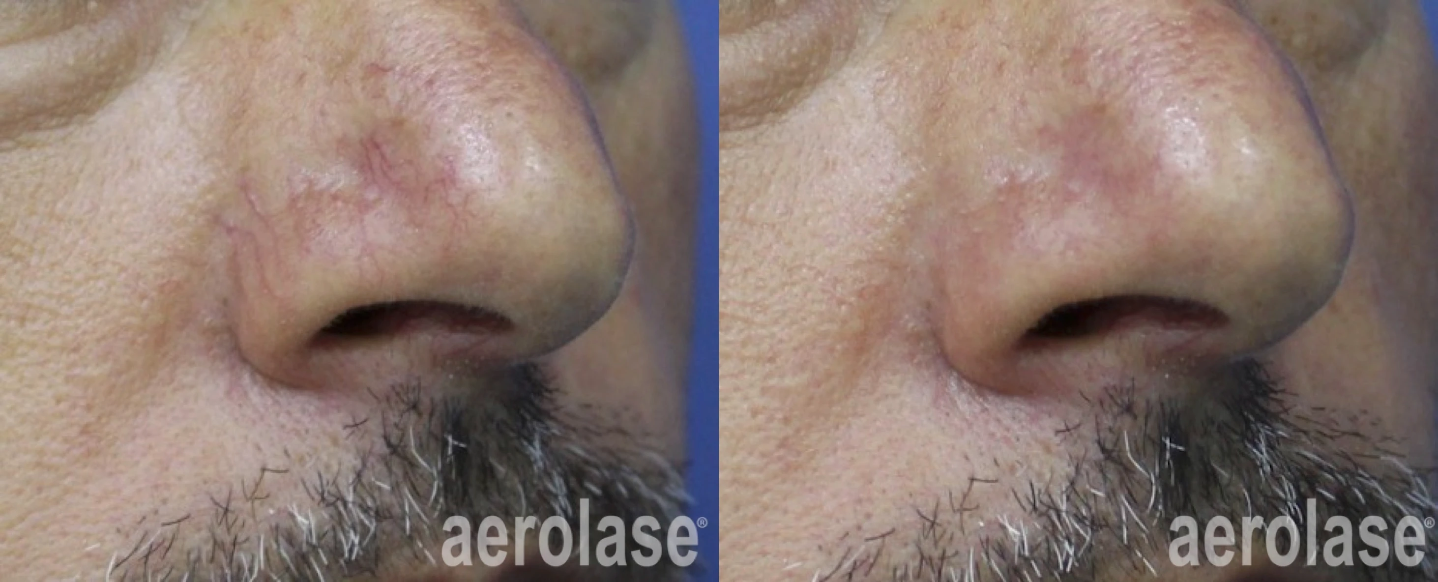 Facial Veins before and after — Aerolase Neo Elite