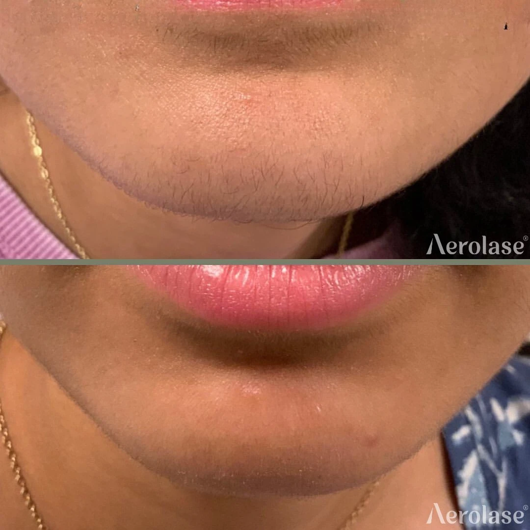 Hair Removal before and after — Aerolase Neo Elite