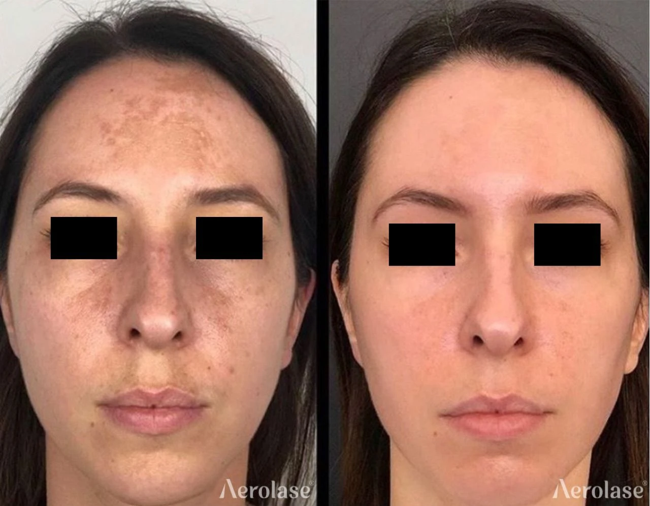 Melasma pigmentation before and after with the Aerolase Neo