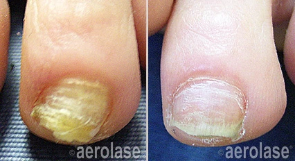 Nail Fungus before and after — Aerolase Neo Elite