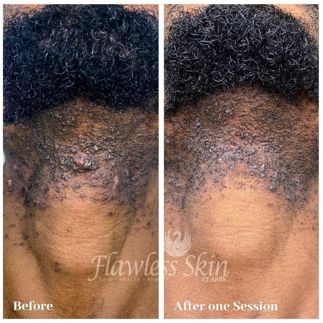 PFB (Ingrown Hair) before and after — Aerolase Neo Elite