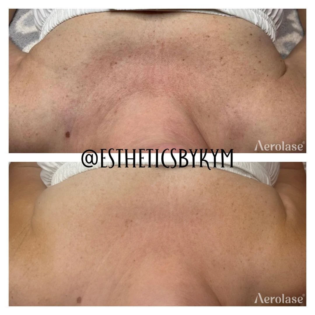 Hyperpigmentation · 4 Treatments before and after — Aerolase Neo Elite