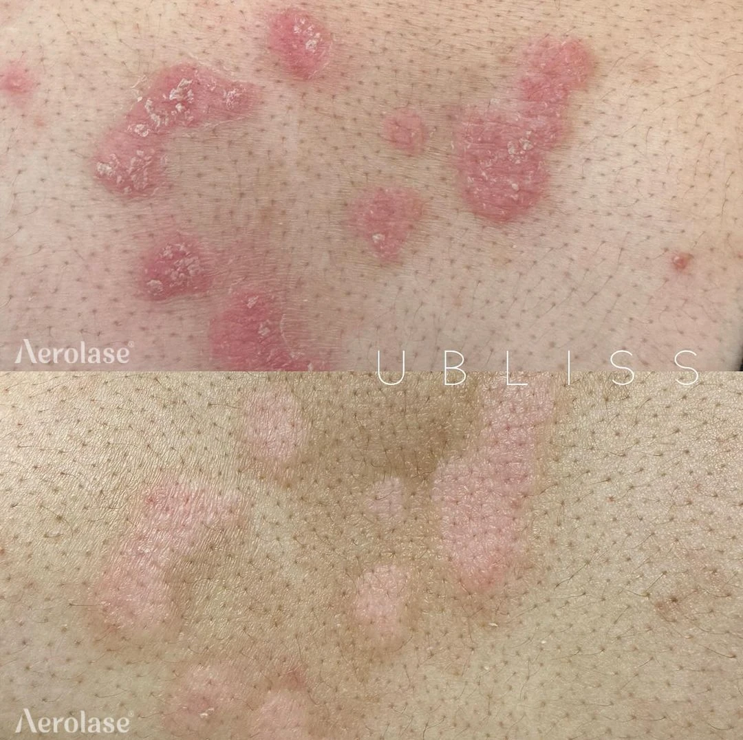 Psoriasis before and after — Aerolase Neo Elite
