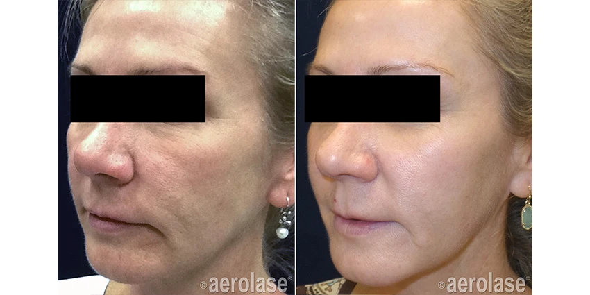 Skin rejuvenation and tightening results with the Aerolase Neo