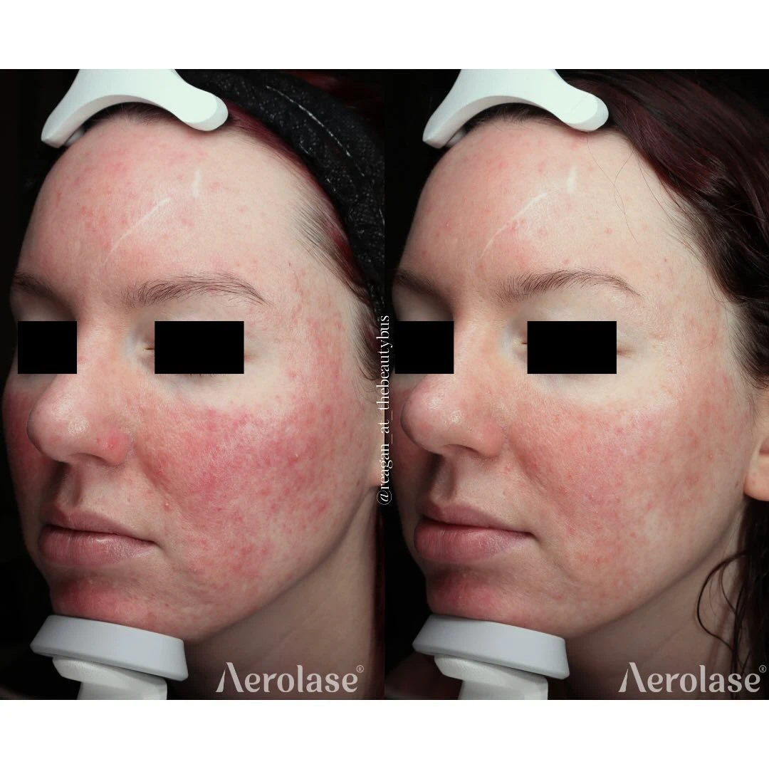 Rosacea and facial redness before and after with the Aerolase Neo