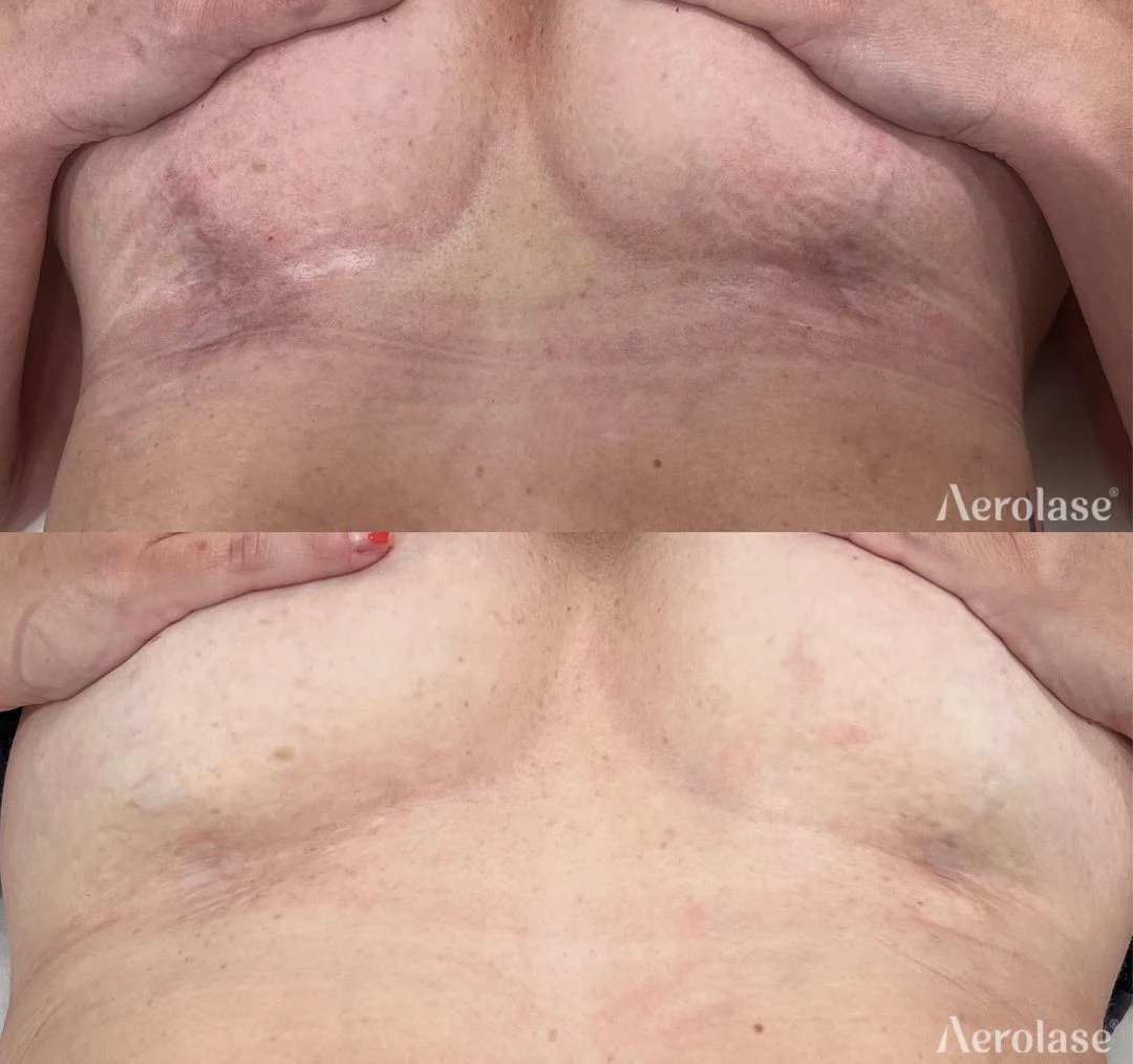 Scar Reduction · 3 Treatments before and after — Aerolase Neo Elite