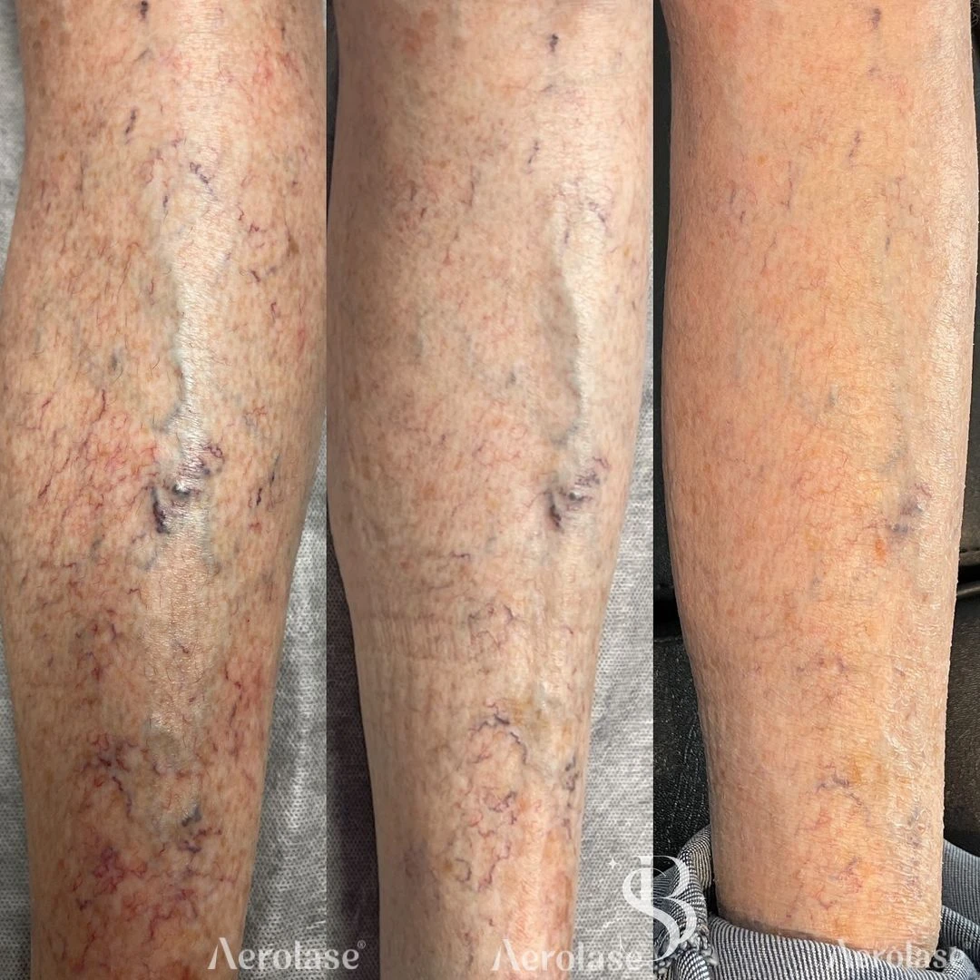 Spider Veins · 3 Treatments before and after — Aerolase Neo Elite