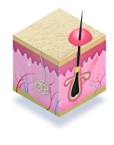How acne forms diagram