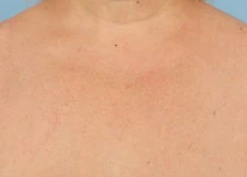 Pigmentation