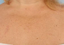 Sun & Age Spots