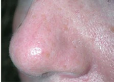 Vascular Lesions