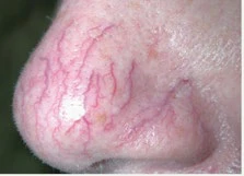 Diffuse Redness