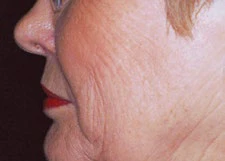 Wrinkles