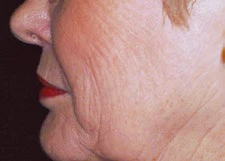 Wrinkles · Before