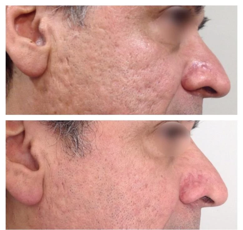 Anti-Aging results