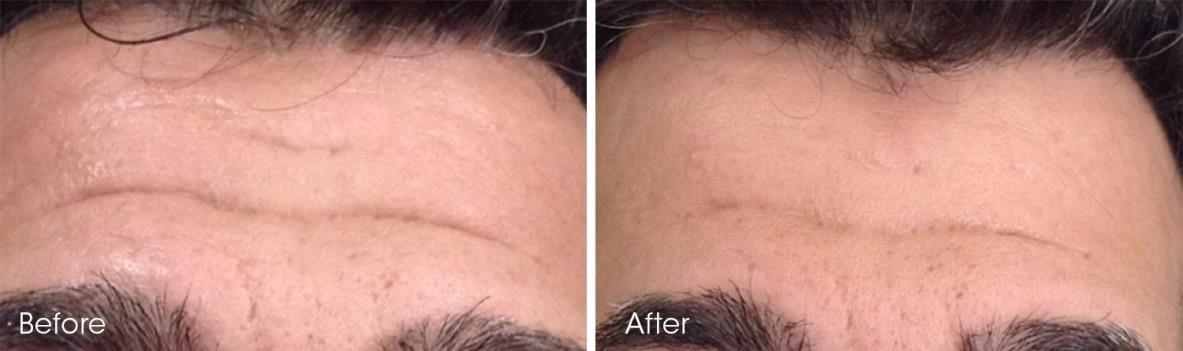 Before and after — Dermaroller TWIST microneedling