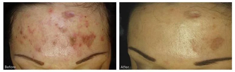 Before and after — Dermaroller TWIST microneedling