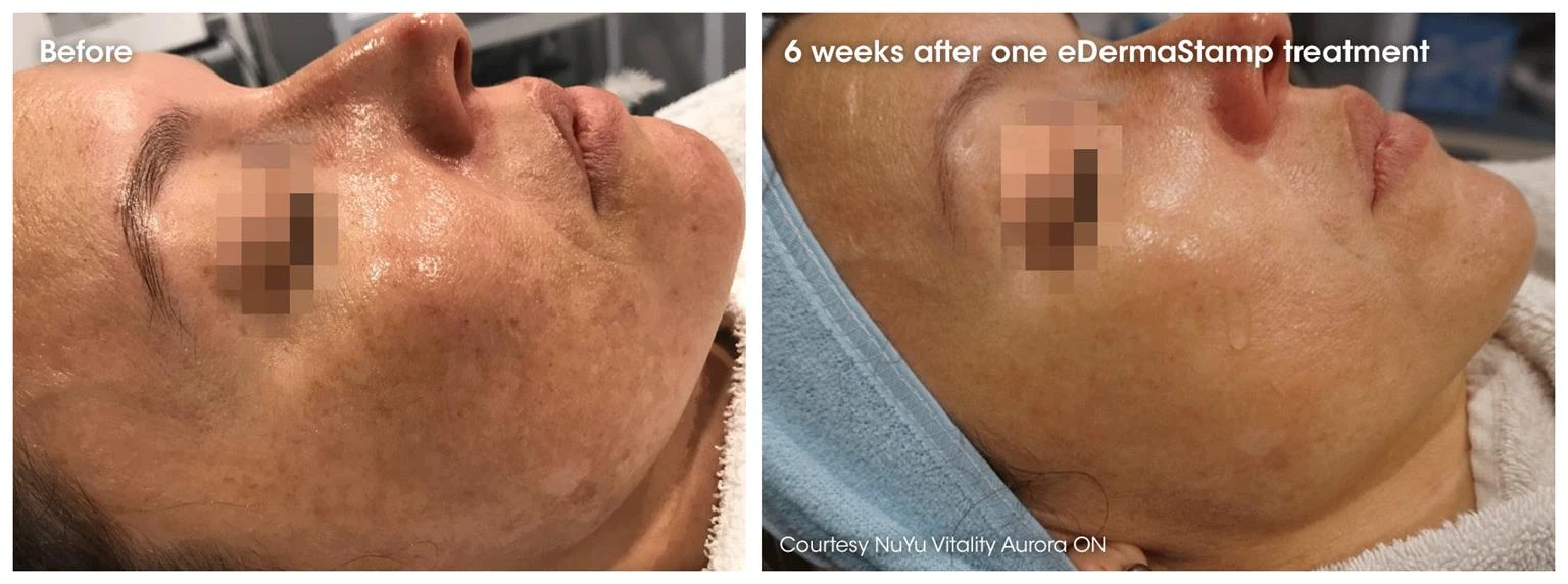 Before and after — Dermaroller TWIST microneedling