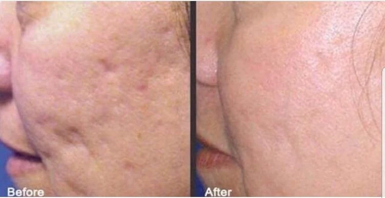 Before and after — Dermaroller TWIST microneedling