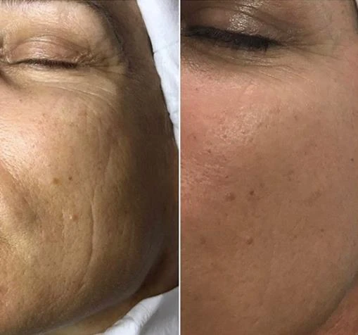 Before and after — Dermaroller TWIST microneedling