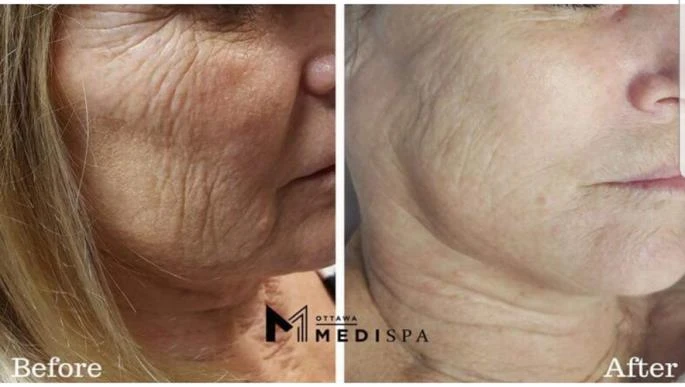 Before and after — Dermaroller TWIST microneedling