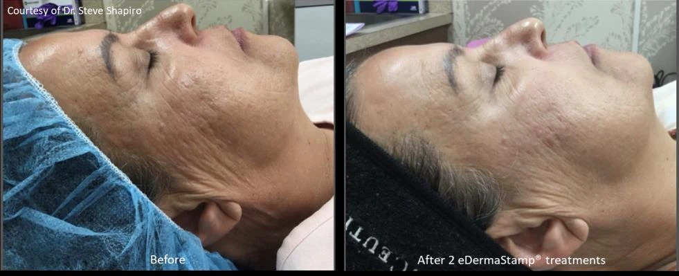 Scars results