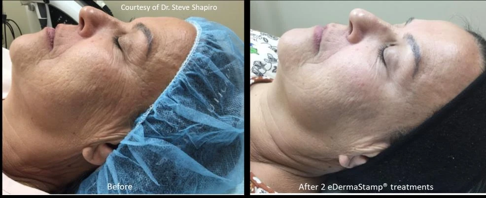 Before and after — Dermaroller TWIST microneedling