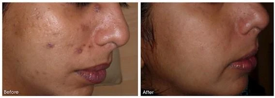 Before and after — Dermaroller TWIST microneedling