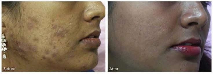 Before and after — Dermaroller TWIST microneedling