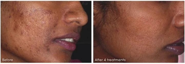 Before and after — Dermaroller TWIST microneedling