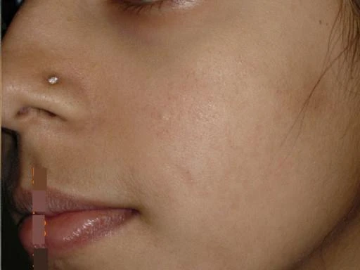 Before and after — Dermaroller TWIST microneedling