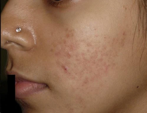 Before and after — Dermaroller TWIST microneedling