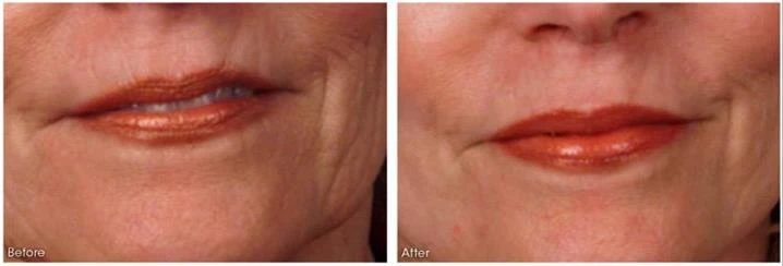 Stretch Marks results