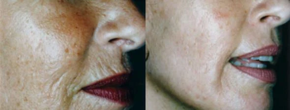Before and after — Dermaroller TWIST microneedling