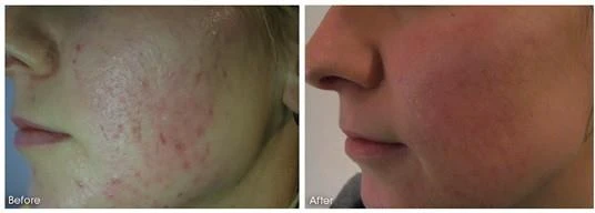 Before and after — Dermaroller TWIST microneedling