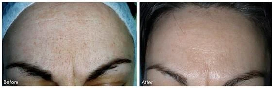 Before and after — Dermaroller TWIST microneedling