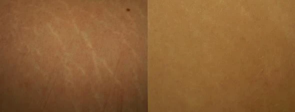 Before and after — Dermaroller TWIST microneedling