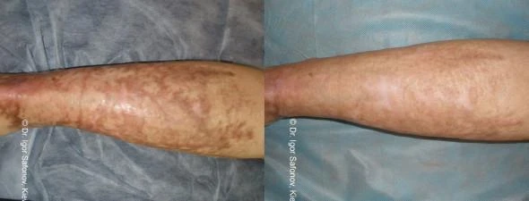 Before and after — Dermaroller TWIST microneedling