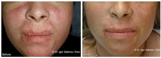 Before and after — Dermaroller TWIST microneedling