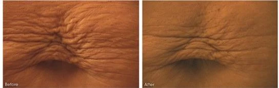 Hyperpigmentation results