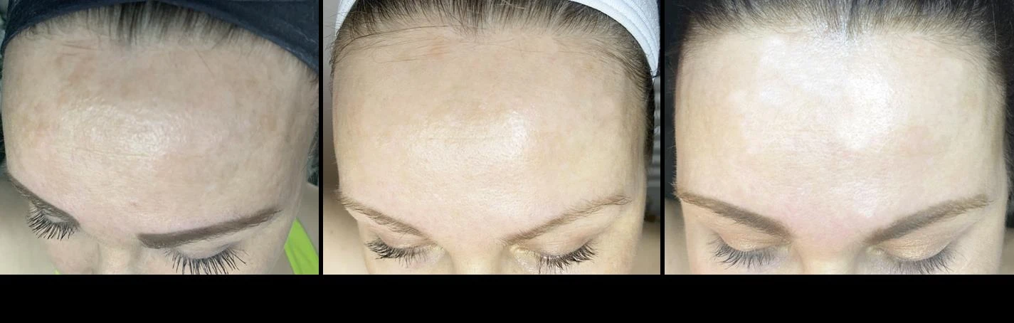 Before and after — Dermaroller TWIST microneedling