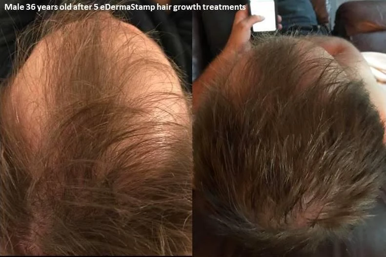 Before and after — Dermaroller TWIST microneedling